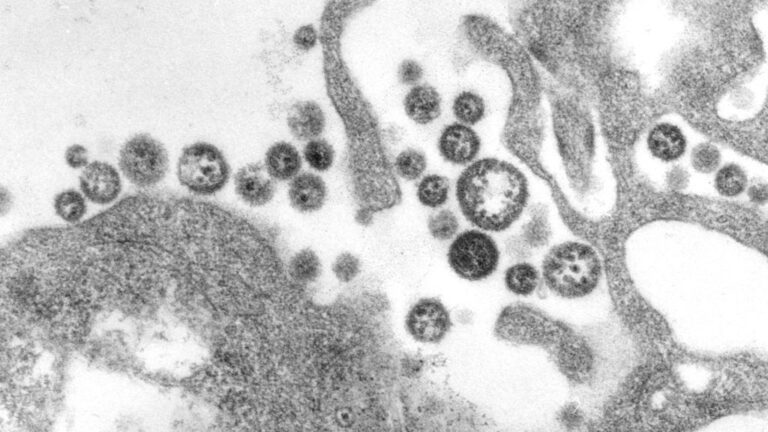 Lassa Fever: U.S. Records First Death in Iowa Case